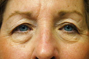 Blepharoplasty 4a